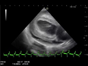 Homogeneous echogenic object in pericardial sac, surrounding the ventricles